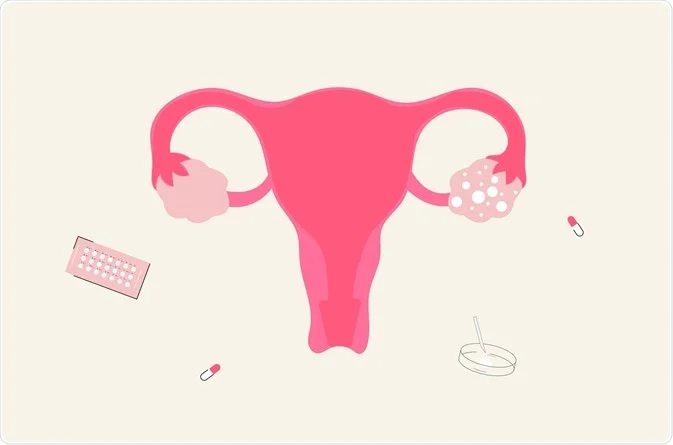 PCOS, infertility, and fertility treatments illustration with uterus and medications